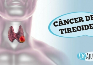 Nódulo no pescoço e rouquidão: quando suspeitar de câncer de tireoide?