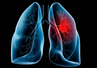 HUST alerta para o câncer de pulmão