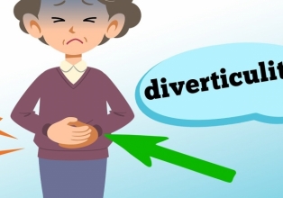 Diverticulite: o que é e quais os sintomas