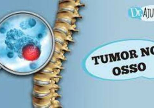Tumor nos ossos: sintomas e diagnósticos