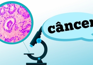 Câncer: entenda o diagnóstico