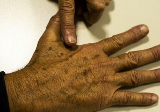 Dezembro Laranja: Câncer de pele é o mais comum no Brasil. saiba como evitar