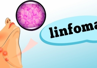 LINFOMA: descubra os sintomas e fatores de risco